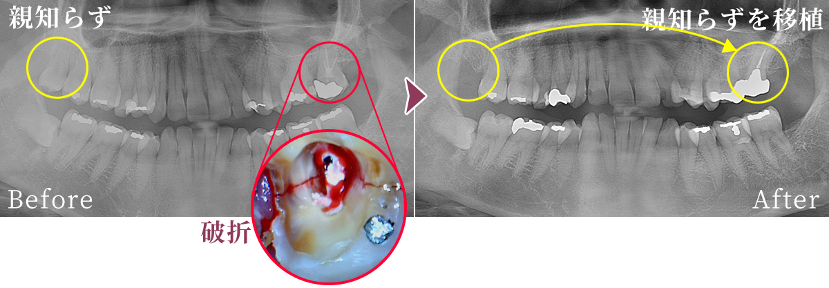 歯牙移植の症例