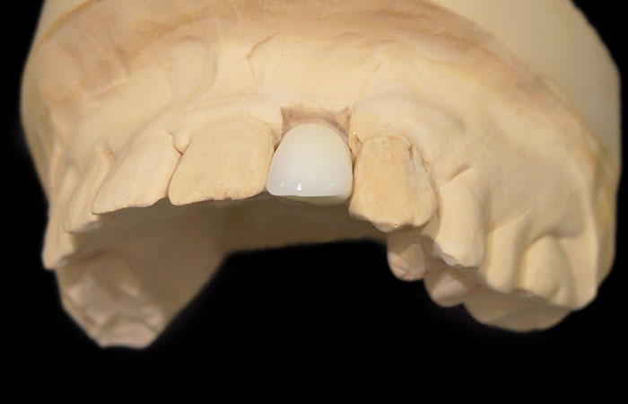 人工歯冠の製作
