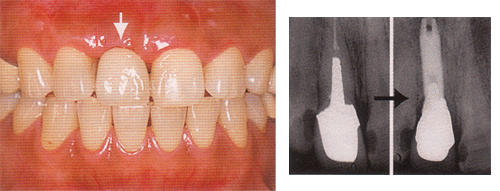 インプラント：歯を一本だけ失った単独歯のケース