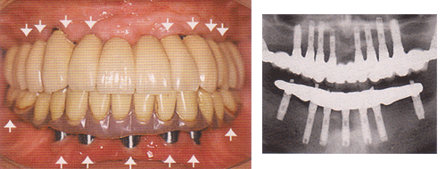 インプラント：歯をすべて失った無歯顎ケース