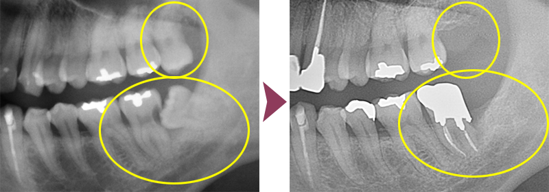 親知らず抜歯症例
