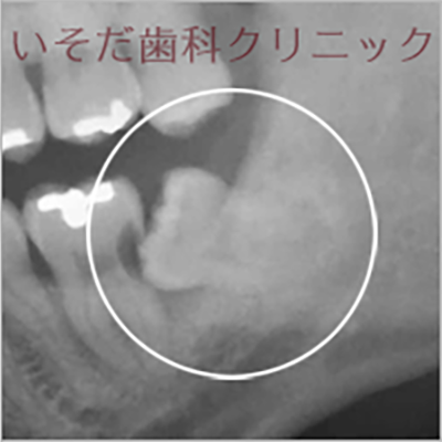 親知らずの抜歯