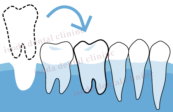 親知らずの抜歯