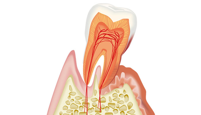 歯周病治療