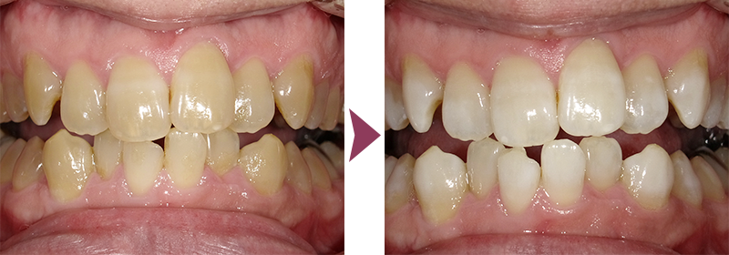 ホワイトニング症例
