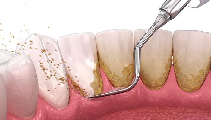 歯石除去